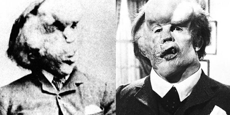 Joseph Merrick, l’uomo elefante